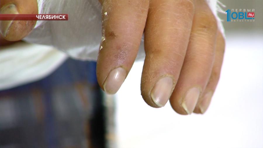 Челябинские хирурги спасли южноуральцу руку, которую он потерял на лесопилке