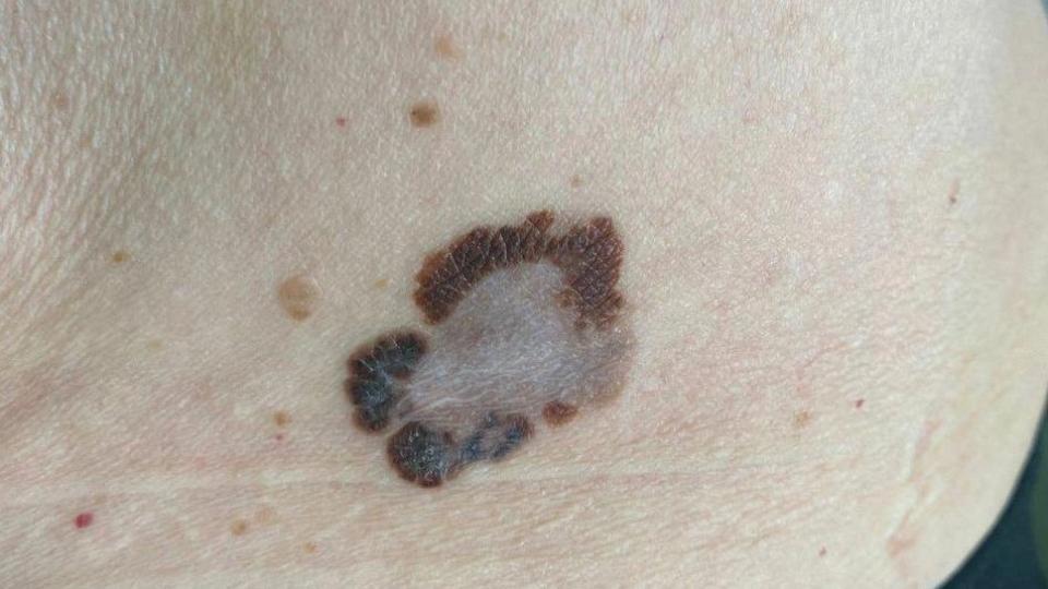 За год Челябинский онкоцентр пролечил более 300 пациентов с меланомой кожи