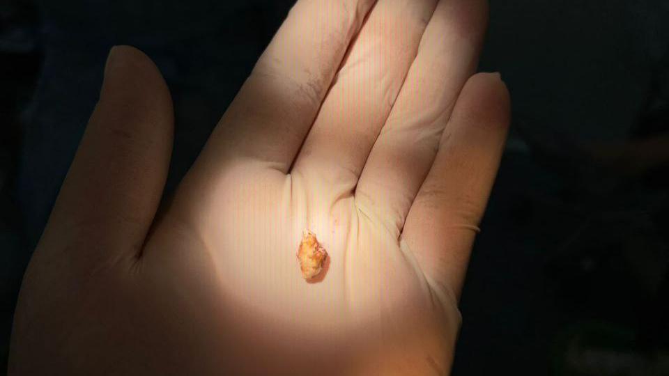 В Магнитогорске впервые провели лапароскопическую операцию на поджелудочной железе