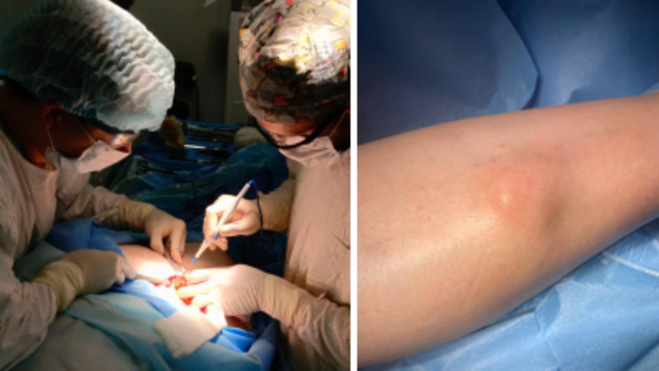 В Челябинском онкоцентре впервые выполнили сложнейшую костнопластическую операцию