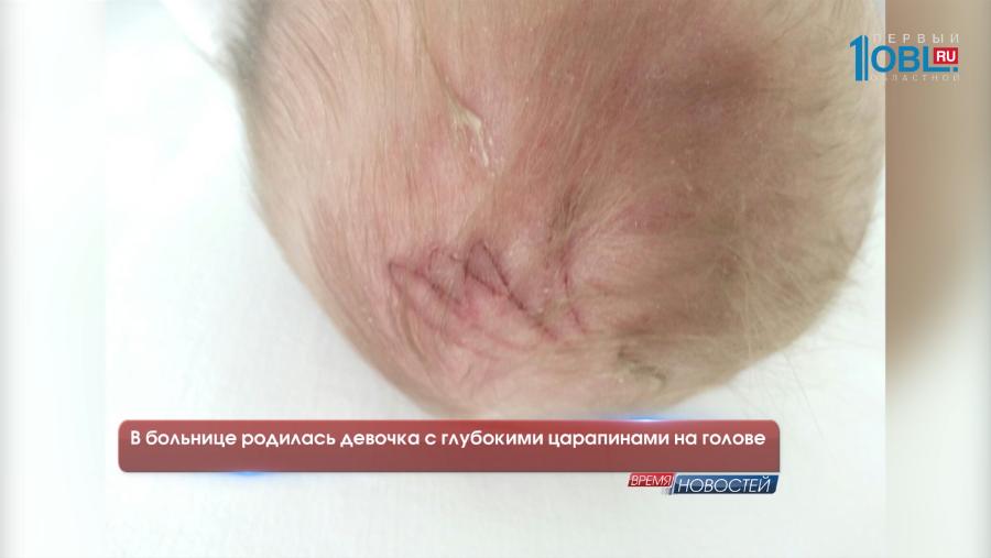 В больнице родилась девочка с глубокими царапинами на голов