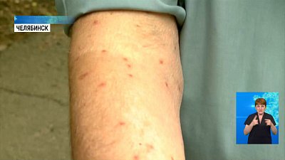 Зуд после купания: аллергия или укусы?