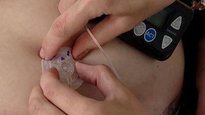 Челябинке с диабетом удалось добиться бесплатных расходников для инсулиновой помпы