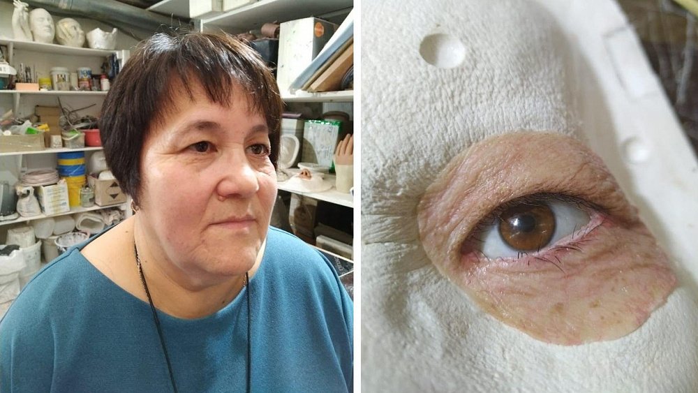 В Челябинске для медсестры сделали глазной протез с искусственной кожей