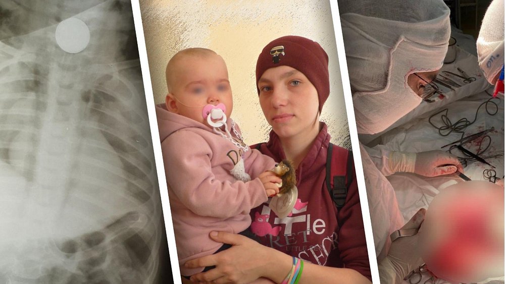 Челябинские хирурги спасли жизнь 11‑месячной девочке, проглотившей батарейку