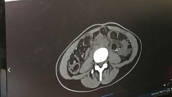 Челябинские врачи прооперировали 20‑летнюю девушку с почкой в форме подковы