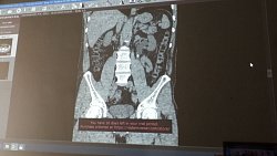 Челябинские хирурги начали удалять камни из почек гибридным способом