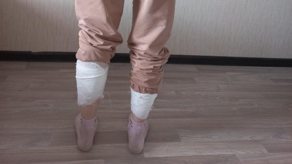 СК проводит проверку после нападения собаки на 14‑летнюю девочку в Чебаркуле