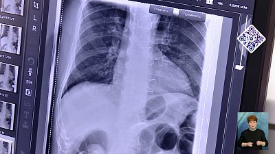 Пациент проглотил золото соседа