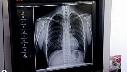 В Челябинской области людей с ВИЧ обеспечат бесплатным углубленным обследованием на туберкулез