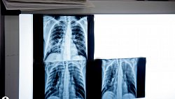 В Челябинской области людей с ВИЧ обеспечат бесплатным углубленным обследованием на туберкулез