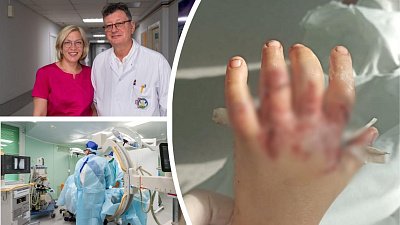 Челябинские врачи сохранили двухлетнему ребенку пальцы, отрубленные мангалом