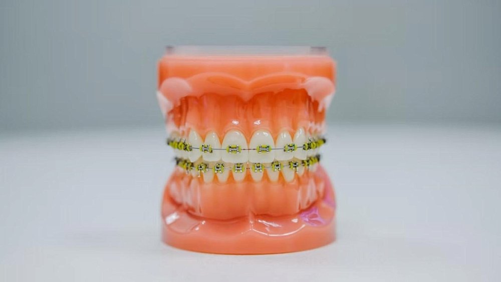 Надо ли удалять зубы мудрости при постановке брекетов