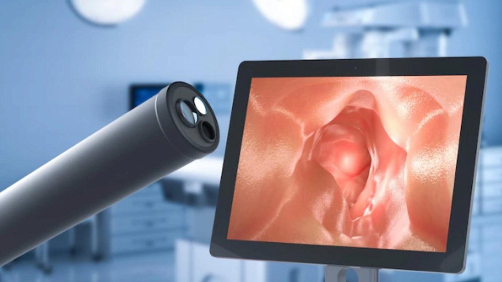 Обязательно ли удалять полипы кишечника