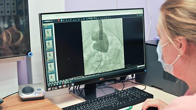 В Челябинске облегчают жизнь пациентов с раком прямой кишки