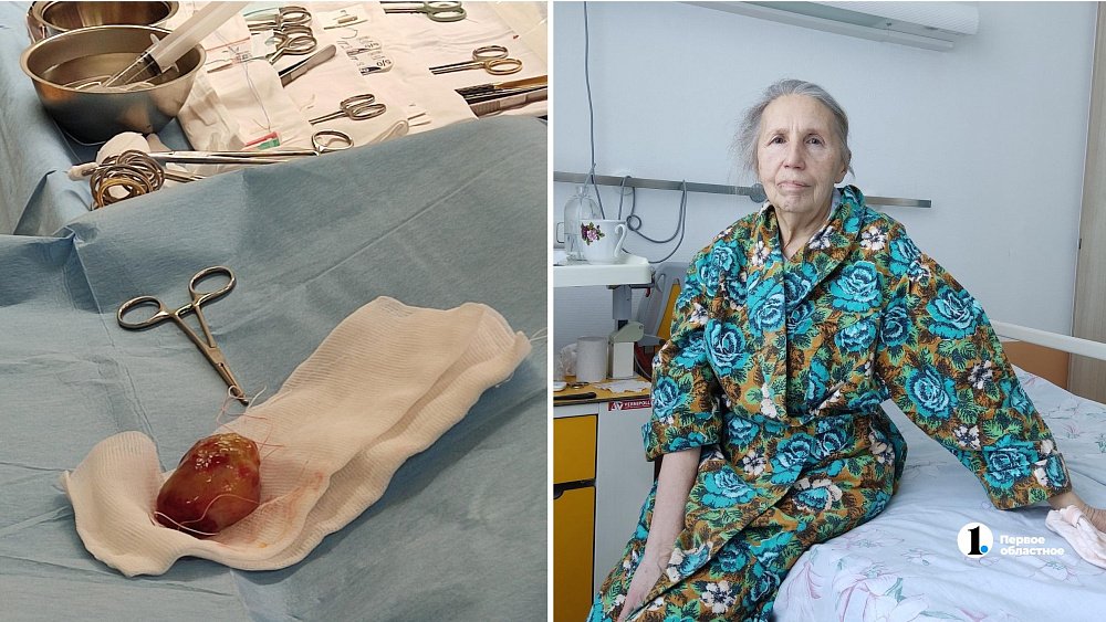 Челябинские врачи удалили из сердца пенсионерки опухоль с абрикос