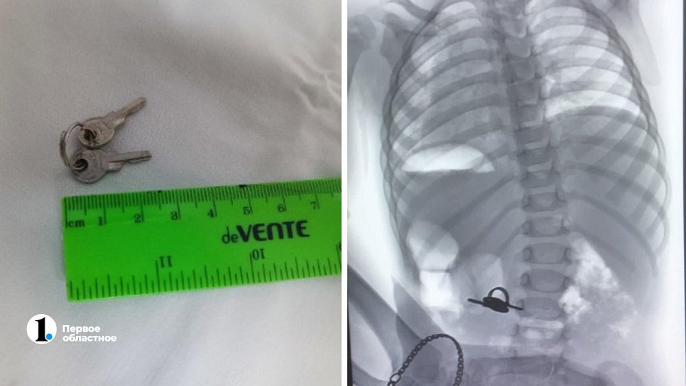 В Челябинске полуторагодовалый ребенок проглотил связку ключей