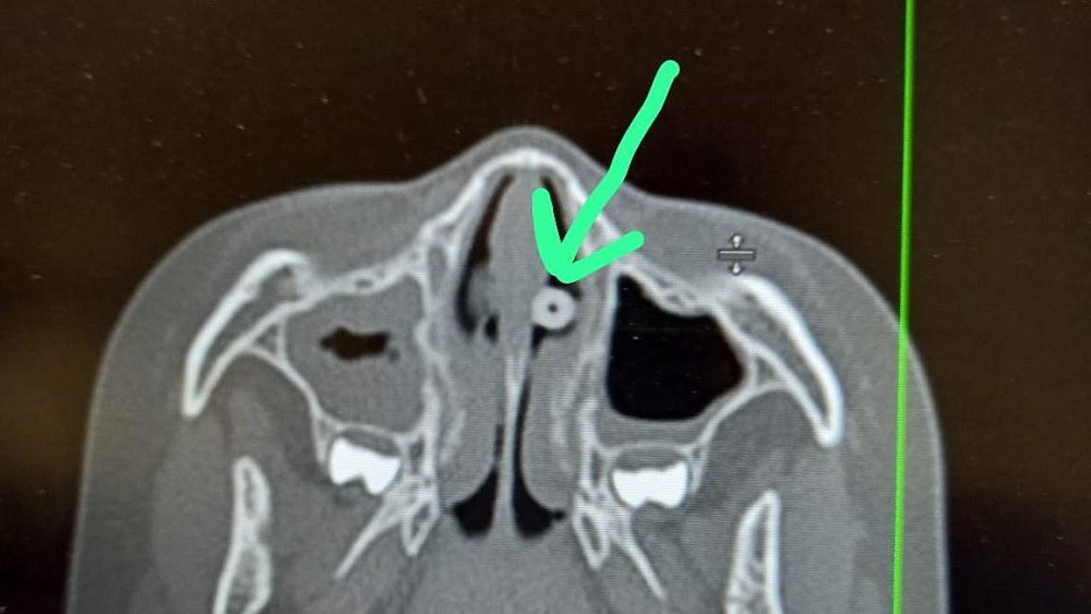 В Магнитогорске врачи на КТ нашли бусинку в голове у ребенка