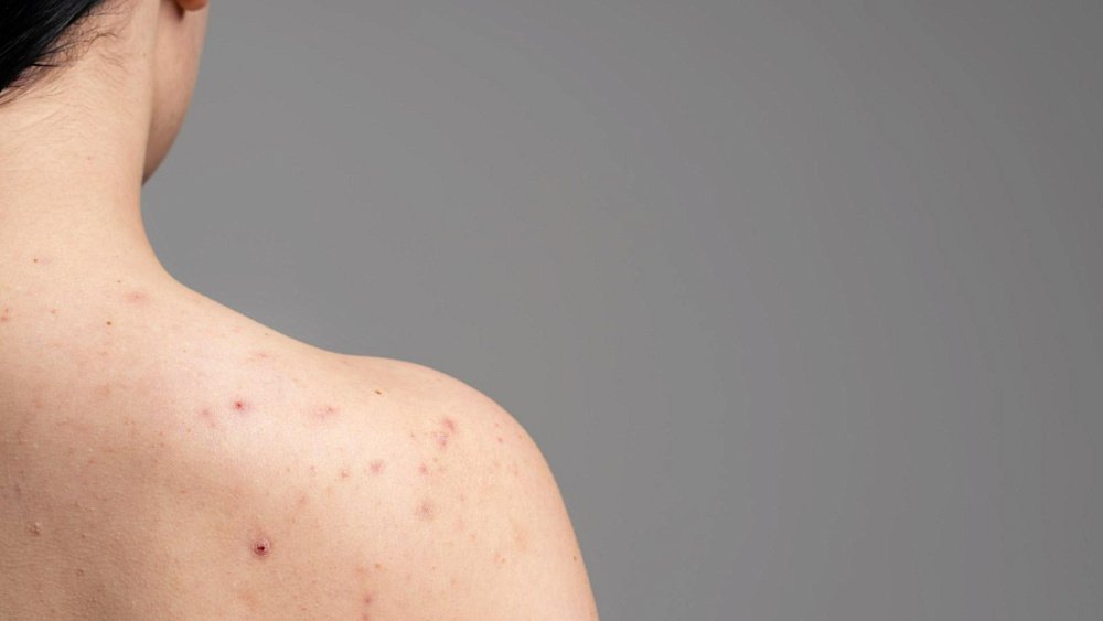 Причины появления акне на спине