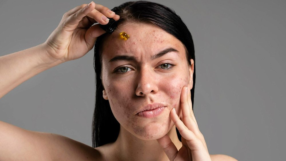 Чего не стоит делать при акне