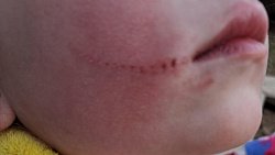 В Кусе 5-летняя девочка упала в колодец с арматурой