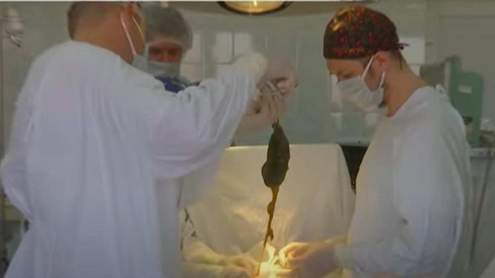 В Магнитогорске хирурги достали из желудка ребенка полкило волос