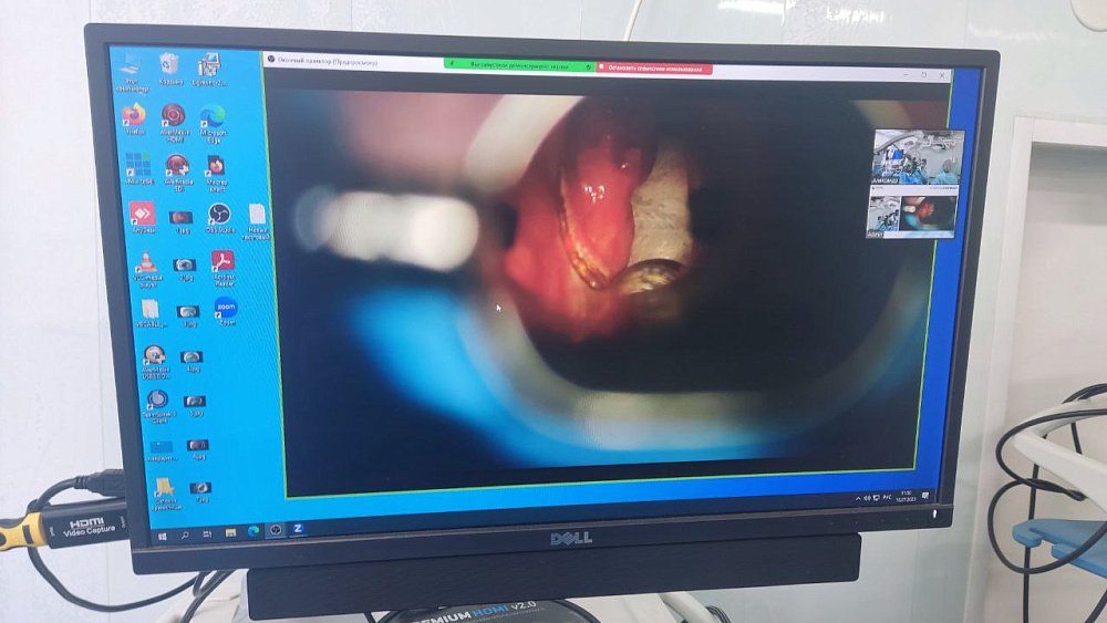 Челябинские онкологи удалили через рот опухоль гортани в ходе прямого эфира