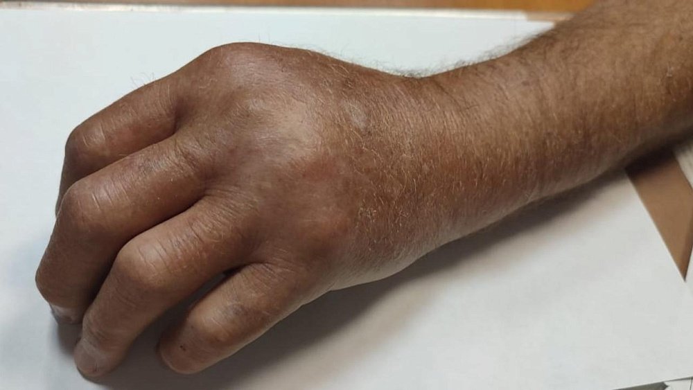 В Челябинской области пенсионер попал в больницу после укуса гадюки