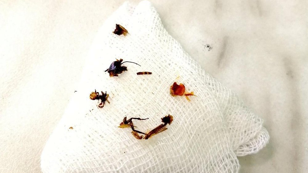 В Челябинске врачи вытащили из уха двухлетнего ребенка таракана