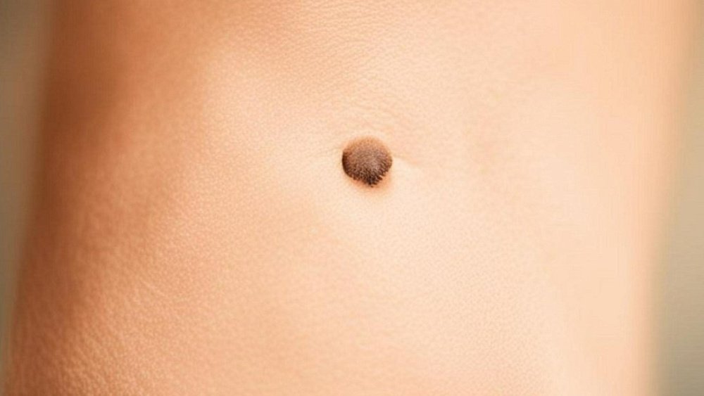 В Челябинске медики бесплатно проверят родинки всем желающим