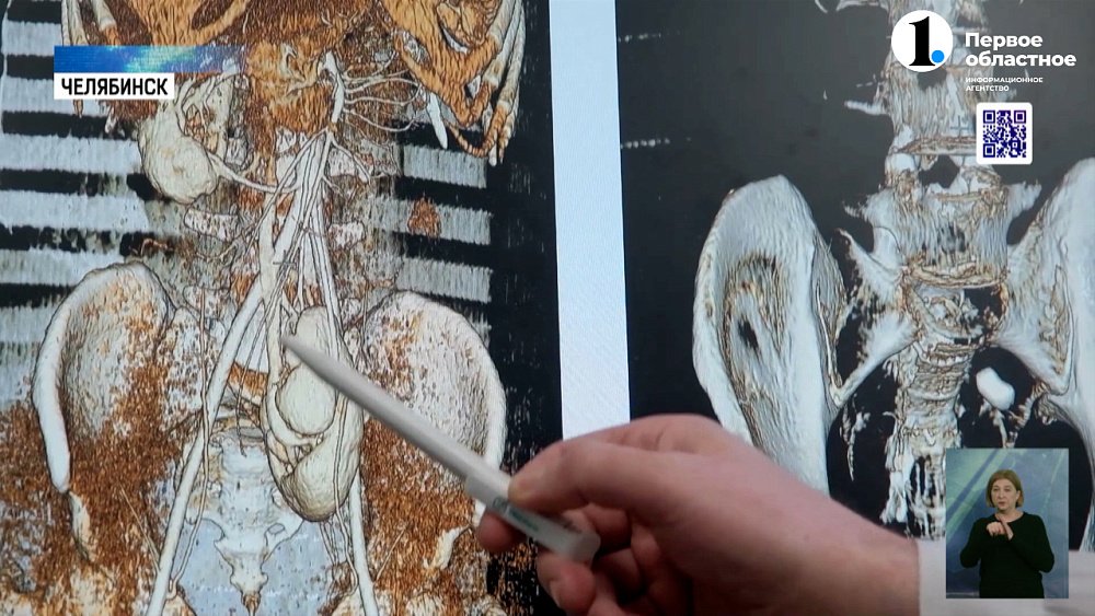 Урологи ЧОКБ провели уникальную операцию на почке