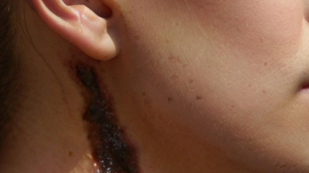 Чаще меланома образуется из уже существующей родинки