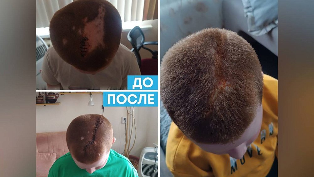 Челябинские хирурги восстановили мальчику потерянные из‑за ожога волосы