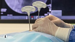 «Костный цемент» избавляет от боли в спине челябинских пациентов