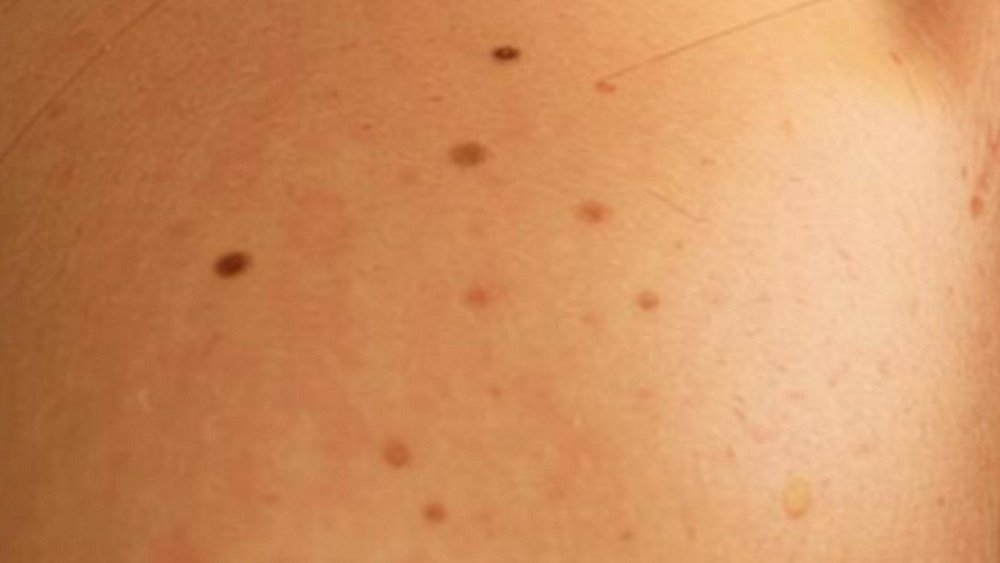 Проверьте свои родинки по правилу ФИГАРО