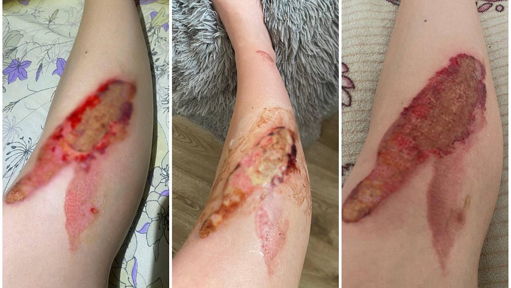 Жительница Челябинска получила ожог ноги в автобусе