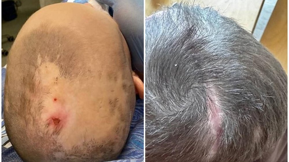 Челябинские врачи избавили трехлетнего малыша от огромной залысины