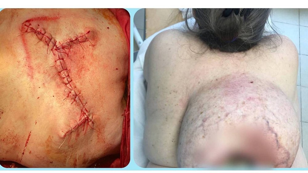 Жительница Миасса 10 лет носила на спине шестикилограммовый жировик