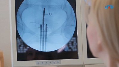 В Челябинском онкоцентре рассказали о лечении рака с помощью брахитерапии