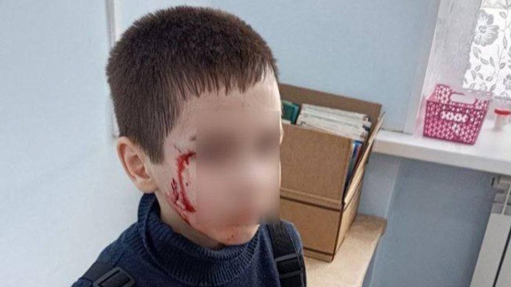 Житель Аргаяша выплатит 100 тысяч ребенку, покусанному его собакой