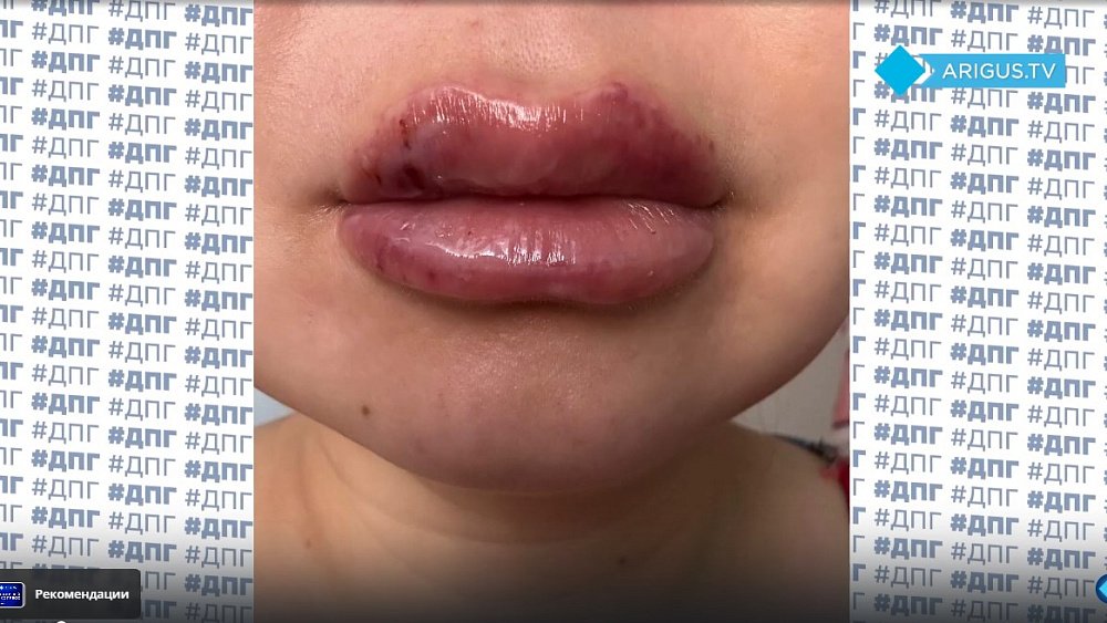 Девушка оказалась изуродована после укола красоты