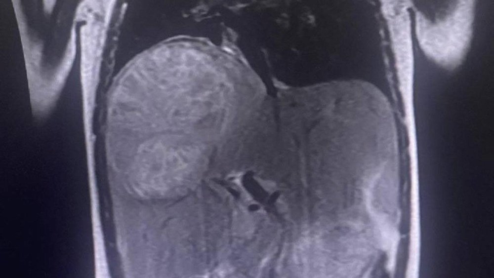 Челябинские хирурги вырезали 12‑см кисту с паразитами у 4‑летнего ребенка