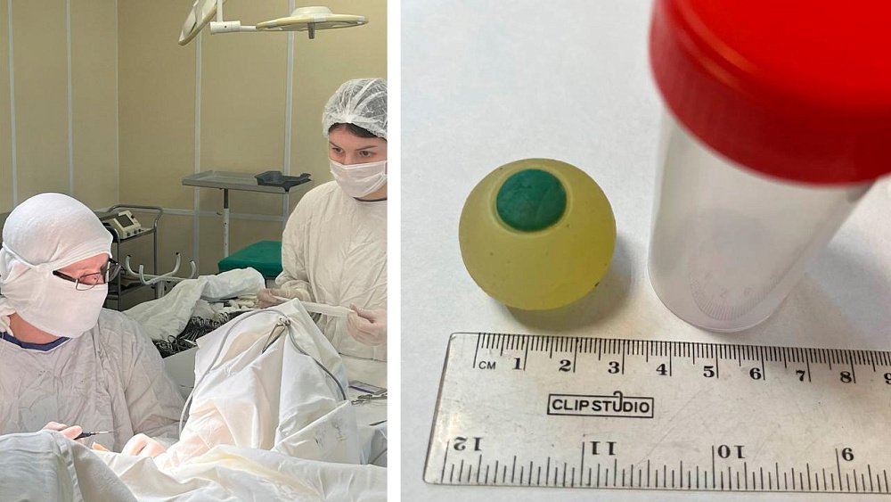 Челябинские врачи извлекли силиконовый глаз из кишечника 9‑летнего мальчика