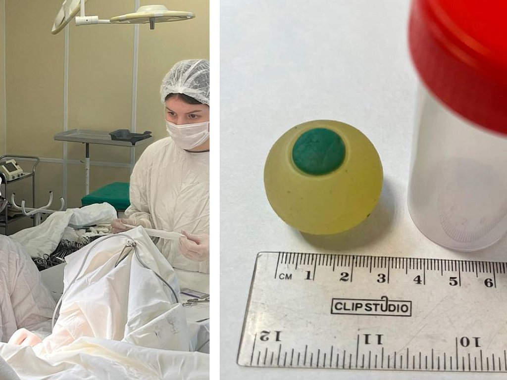 Челябинские врачи извлекли силиконовый глаз из кишечника 9‑летнего мальчика