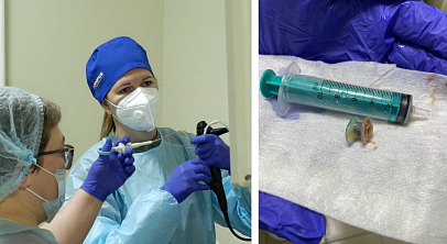 Челябинские врачи спасли мужчину с провалившимся в бронхи голосовым протезом