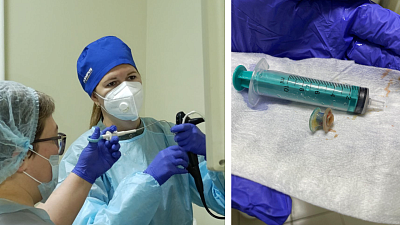 Челябинские врачи спасли мужчину с провалившимся в бронхи голосовым протезом