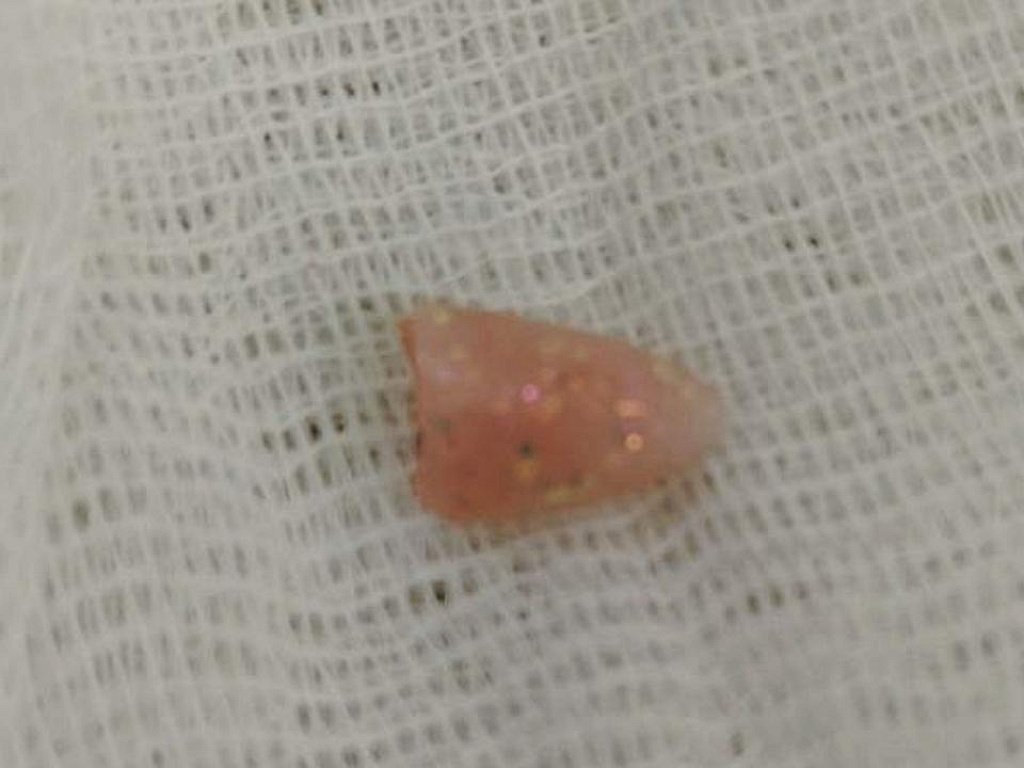 «Вытащили и обалдели»: 10‑месячный ребенок подавился наращенным ногтем матери