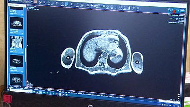 В Челябинске начал работу центр лечения рака печени