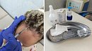 В Челябинске мигрень лечат уколами красоты по ОМС