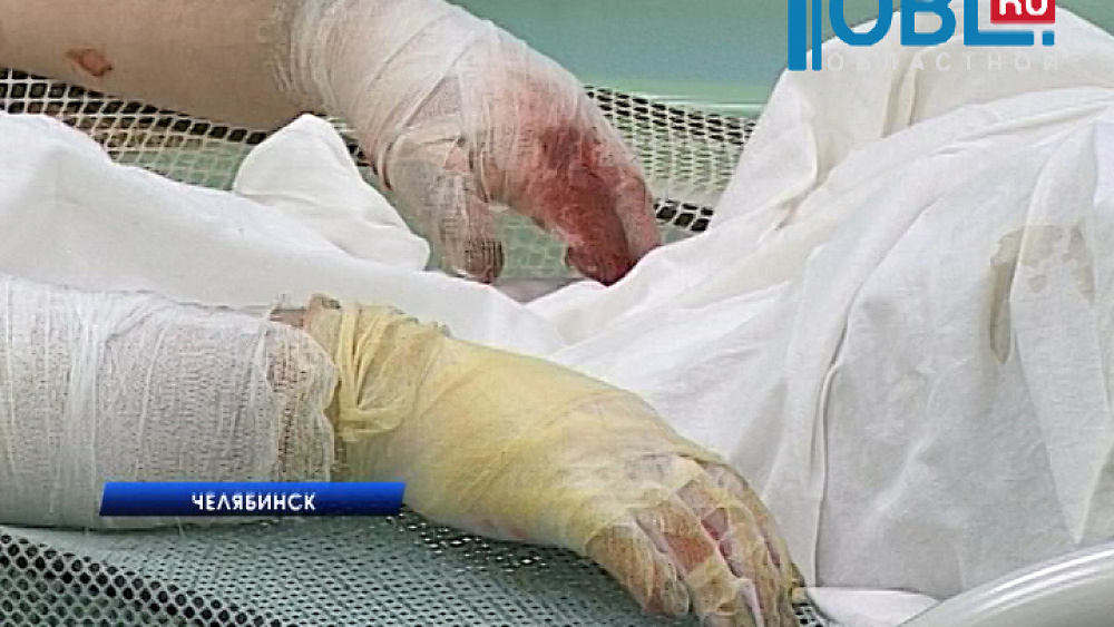 Трое рабочих ЧМЗ получили глубокие ожоги 